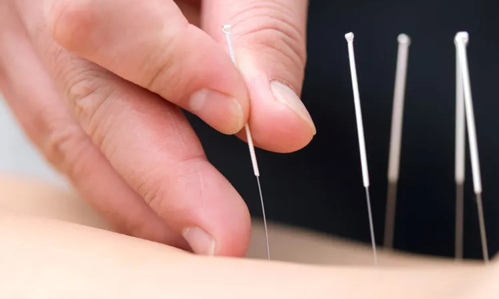 Agopuntura e Fibromialgia